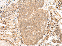 Immunohistochemistry of paraffin-embedded Human esophagus cancer tissue using VPS50 Polyclonal Antibody at dilution of 1:45 (×200)