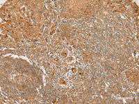 Immunohistochemistry of paraffin-embedded Human tonsil tissue using FLNC Polyclonal Antibody at dilution of 1:30 (×200)