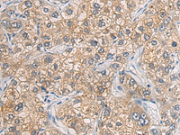 Immunohistochemistry of paraffin-embedded Human liver cancer tissue using GAB4 Polyclonal Antibody at dilution of 1:60 (×200)