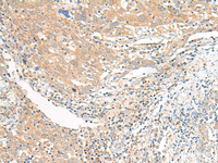 Immunohistochemistry of paraffin-embedded Human cervical cancer tissue using SLC6A9 Polyclonal Antibody at dilution of 1:25 (×200)
