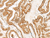 Immunohistochemistry of paraffin-embedded Human thyroid cancer tissue using NUP210 Polyclonal Antibody at dilution of 1:30 (×200)