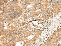Immunohistochemistry of paraffin-embedded Human colorectal cancer tissue using ADGRF5 Polyclonal Antibody at dilution of 1:40 (×200)