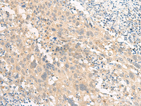 Immunohistochemistry of paraffin-embedded Human cervical cancer tissue using GPR22 Polyclonal Antibody at dilution of 1:50 (×200)