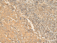 Immunohistochemistry of paraffin-embedded Human cervical cancer tissue using RPS28 Polyclonal Antibody at dilution of 1:30 (×200)