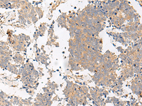 Immunohistochemistry of paraffin-embedded Human lung cancer tissue using GPR153 Polyclonal Antibody at dilution of 1:40 (×200)
