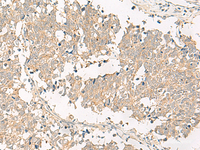 Immunohistochemistry of paraffin-embedded Human lung cancer tissue using GPR161 Polyclonal Antibody at dilution of 1:40 (×200)