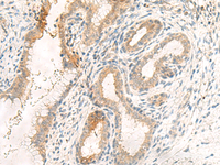 Immunohistochemistry of paraffin-embedded Human cervical cancer tissue using GPR89A/GPR89B Polyclonal Antibody at dilution of 1:25 (×200)
