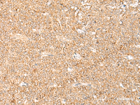 Immunohistochemistry of paraffin-embedded Human ovarian cancer tissue using LGALSL Polyclonal Antibody at dilution of 1:70 (×200)