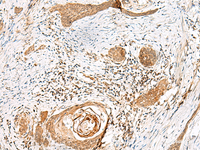 Immunohistochemistry of paraffin-embedded Human esophagus cancer tissue using GSTM2 Polyclonal Antibody at dilution of 1:50 (×200)