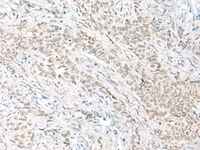 Immunohistochemistry of paraffin-embedded Human ovarian cancer tissue using HABP4 Polyclonal Antibody at dilution of 1:60 (×200)