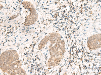 Immunohistochemistry of paraffin-embedded Human esophagus cancer tissue using SNRPG Polyclonal Antibody at dilution of 1:40 (×200)