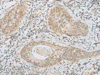 Immunohistochemistry of paraffin-embedded Human esophagus cancer tissue using HELT Polyclonal Antibody at dilution of 1:40 (×200)