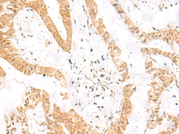 Immunohistochemistry of paraffin-embedded Human liver cancer tissue using HES7 Polyclonal Antibody at dilution of 1:25 (×200)