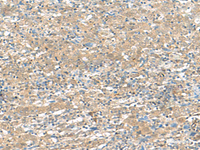 Immunohistochemistry of paraffin-embedded Human cervical cancer tissue using HMBOX1 Polyclonal Antibody at dilution of 1:30 (×200)