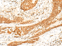 Immunohistochemistry of paraffin-embedded Human esophagus cancer tissue using HNF4A Polyclonal Antibody at dilution of 1:40 (×200)