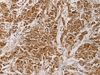 Immunohistochemistry of paraffin-embedded Human colorectal cancer tissue using HOXC5 Polyclonal Antibody at dilution of 1:55 (×200)