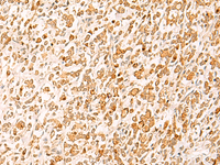 Immunohistochemistry of paraffin-embedded Human gastric cancer tissue using HTT Polyclonal Antibody at dilution of 1:25 (×200)