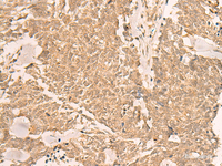 Immunohistochemistry of paraffin-embedded Human lung cancer tissue using IL1RAPL2 Polyclonal Antibody at dilution of 1:25 (×200)