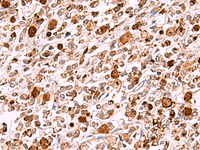 Immunohistochemistry of paraffin-embedded Human gastric cancer tissue using INO80 Polyclonal Antibody at dilution of 1:85 (×200)