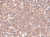 Immunohistochemistry of paraffin-embedded Human tonsil tissue using MAPK8IP3 Polyclonal Antibody at dilution of 1:45 (×200)