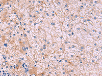 Immunohistochemistry of paraffin-embedded Human liver cancer tissue using JAM3 Polyclonal Antibody at dilution of 1:40 (×200)