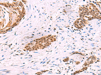 Immunohistochemistry of paraffin-embedded Human esophagus cancer tissue using CREBBP Polyclonal Antibody at dilution of 1:35 (×200)