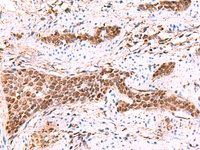 Immunohistochemistry of paraffin-embedded Human esophagus cancer tissue using SOX2 Polyclonal Antibody at dilution of 1:35 (×200)