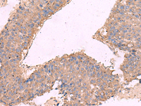 Immunohistochemistry of paraffin-embedded Human liver cancer tissue using KCNN3 Polyclonal Antibody at dilution of 1:40 (×200)