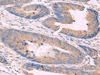 Immunohistochemistry of paraffin-embedded Human colorectal cancer tissue using KCNN3 Polyclonal Antibody at dilution of 1:40 (×200)