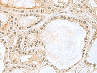 Immunohistochemistry of paraffin-embedded Human thyroid cancer tissue using KDM3B Polyclonal Antibody at dilution of 1:45 (×200)