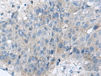 Immunohistochemistry of paraffin-embedded Human liver cancer tissue using KIAA0556 Polyclonal Antibody at dilution of 1:70 (×200)