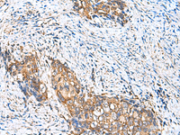 Immunohistochemistry of paraffin-embedded Human cervical cancer tissue using CAMSAP3 Polyclonal Antibody at dilution of 1:110 (×200)