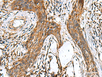 Immunohistochemistry of paraffin-embedded Human esophagus cancer tissue using TTR Polyclonal Antibody at dilution of 1:50 (×200)