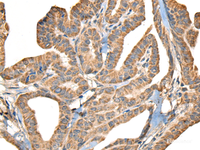 Immunohistochemistry of paraffin-embedded Human thyroid cancer tissue using SLAMF7 Polyclonal Antibody at dilution of 1:30 (×200)