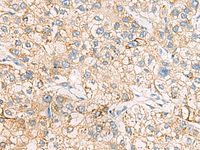 Immunohistochemistry of paraffin-embedded Human liver cancer tissue using HMOX1 Polyclonal Antibody at dilution of 1:70 (×200)
