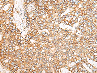 Immunohistochemistry of paraffin-embedded Human liver cancer tissue using NME4 Polyclonal Antibody at dilution of 1:45 (×200)