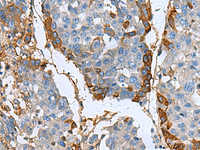 Immunohistochemistry of paraffin-embedded Human liver cancer tissue using TGFBI Polyclonal Antibody at dilution of 1:60 (×200)