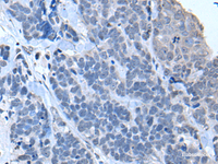 Immunohistochemistry of paraffin-embedded Human thyroid cancer tissue using TIA1 Polyclonal Antibody at dilution of 1:30 (×200)