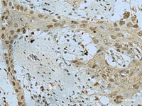 Immunohistochemistry of paraffin-embedded Human esophagus cancer tissue using WDR4 Polyclonal Antibody at dilution of 1:40 (×200)