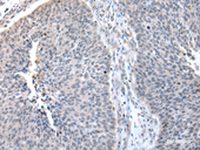 Immunohistochemistry of paraffin-embedded Human lung cancer tissue using ZNF23 Polyclonal Antibody at dilution of 1:50 (×200)