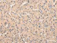 Immunohistochemistry of paraffin-embedded Human liver cancer tissue using ZNF268 Polyclonal Antibody at dilution of 1:50 (×200)