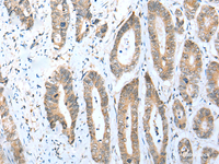 Immunohistochemistry of paraffin-embedded Human gastric cancer tissue using ACBD4 Polyclonal Antibody at dilution of 1:30 (×200)