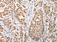 Immunohistochemistry of paraffin-embedded Human breast cancer tissue using ZNF486 Polyclonal Antibody at dilution of 1:50 (×200)