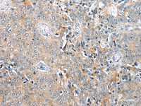 Immunohistochemistry of paraffin-embedded Human prost at e cancer tissue using COMMD6 Polyclonal Antibody at dilution of 1:45 (×200)