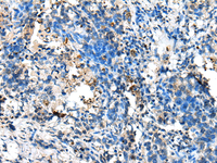 Immunohistochemistry of paraffin-embedded Human lung cancer tissue using NUDT10 Polyclonal Antibody at dilution of 1:70 (×200)