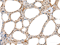 Immunohistochemistry of paraffin-embedded Human thyroid cancer tissue using RAB11A Polyclonal Antibody at dilution of 1:35 (×200)