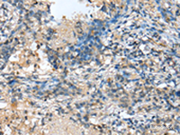 Immunohistochemistry of paraffin-embedded Human lung cancer tissue using MOB4 Polyclonal Antibody at dilution of 1:25 (×200)