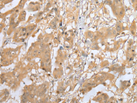 Immunohistochemistry of paraffin-embedded Human breast cancer tissue using MOB4 Polyclonal Antibody at dilution of 1:25 (×200)