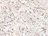 Immunohistochemistry of paraffin-embedded Human prost ate cancer tissue using ZNF281 Polyclonal Antibody at dilution of 1:30 (×200)