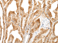 Immunohistochemistry of paraffin-embedded Human thyroid cancer tissue using ZPBP Polyclonal Antibody at dilution of 1:30 (×200)